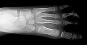 Missing toe birth malformation ,X-ray
