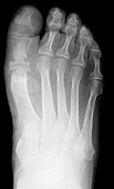 Big toe joint replacement,X-ray