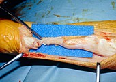 Ruptured Achilles tendon surgery