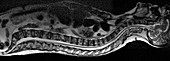 Bone marrow cancer,MRI scan