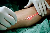 Laser treatment of varicose veins