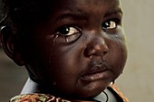 Upset child patient,Uganda