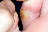 Callus infection on the toe