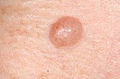 Intradermal mole (naevus) on skin