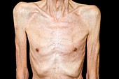 Weight loss in COPD
