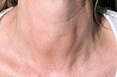 Thyroiditis (swollen thyroids) in neck