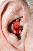 Squamous cell carcinoma in the ear