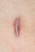 Keloid scar on the abdomen
