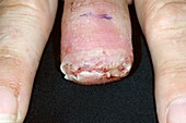 Skin cancer amputation