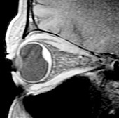 Choroidal haemorrhage of eye,MRI scan