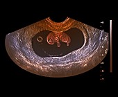 Nine week old foetus,ultrasound scan