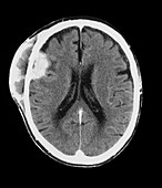 Merkel cancer on the head,CT scan