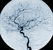 Cerebral aneurysms in Lupus,Angiogram