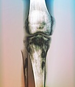 Bacterial bone infection,X-ray
