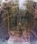 Stent to treat aortic stenosis,X-ray