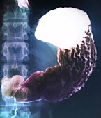 Healthy stomach,barium X-ray