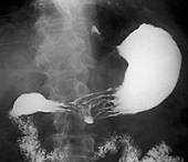 Stomach ulcer,barium X-ray