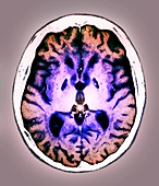 Anoxia brain damage,MRI scan