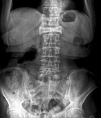 Spinal fracture in osteoporosis,X-ray