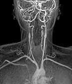 Stenoses in neck arteries,Angio-MRI scan