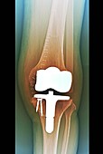 Total knee replacement,X-ray