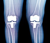 Bilateral total knee replacement,X-ray