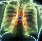 Foreign body in airway of lung,X-ray