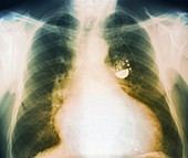 Pacemaker for heart failure,X-ray