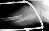 Broken leg in a splint,X-ray