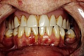 Recession of the gums