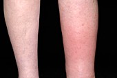 Cellulitis and lymphoedema of the leg