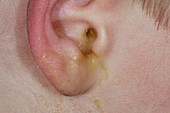 Perforated eardrum with infection