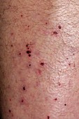 Scratch marks due to eczema