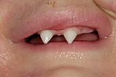 Abnormal teeth in ectodermal dysplasia