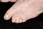 Congenital webbed toes