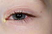 Bacterial conjunctivitis of the eye