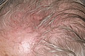 Scalp irritation after shingles