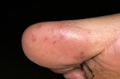 Hand,foot and mouth disease