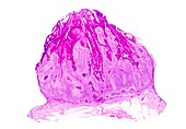 Keratoacanthoma,light micrograph