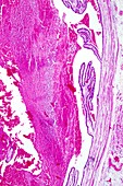 Tubal ectopic pregnancy,light micrograph