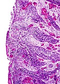 Invasive cervix cancer,light micrograph