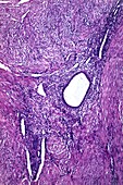 Uterine adenomyosis,light micrograph