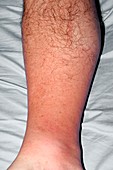 Cellulitis of the leg
