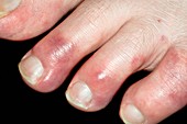 Chilblains of the toes