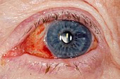 Eye after cataract surgery