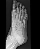 Stress fracture of foot (image 3 of 4)