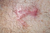 Keloid scar after cancer removal