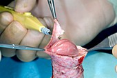 Penis circumcision to treat phimosis