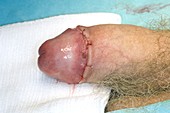 Penis circumcised to treat phimosis