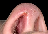Vestibulitis of the nose